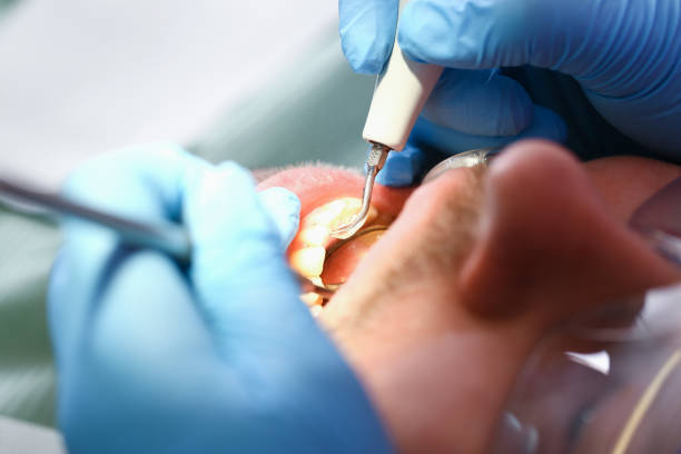 Best Emergency Dentist for Lost Fillings or Crowns in Waycross, GA